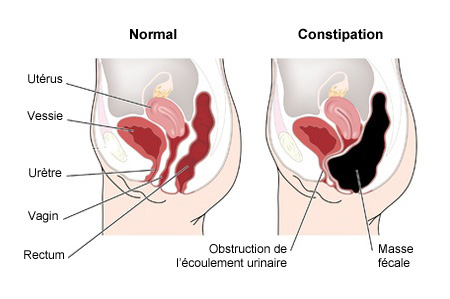 Constipation et homéopathie