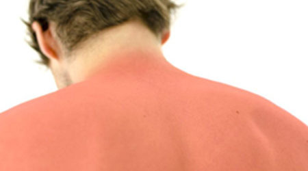 Allergie au soleil : symptômes, prévention et traitements