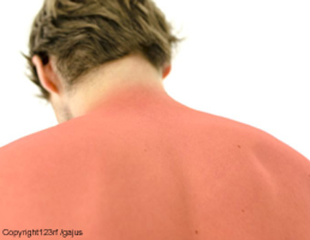 Allergie au soleil : symptômes, prévention et traitements