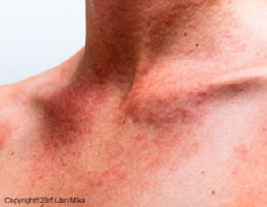 Allergie au soleil : symptômes, prévention et traitements