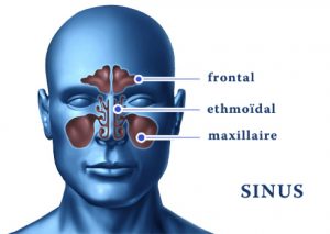 Sinusite mode opératoire