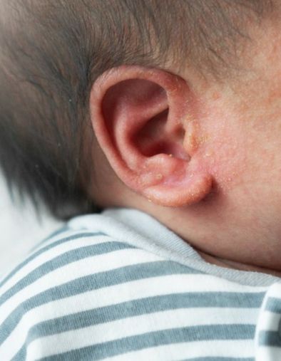 Douleur d’oreille chez un enfant : quels sont les remèdes homéopathiques indiqués
