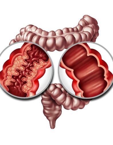 Selon une étude Australienne, la maladie de Crohn provoquera des troubles cognitifs...