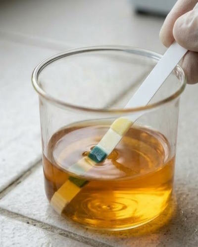 Protéines dans les urines : l’importance d’un geste simple de dépistage