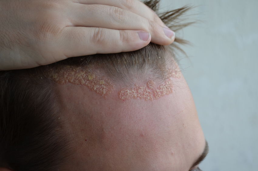 Psoriasis PHC