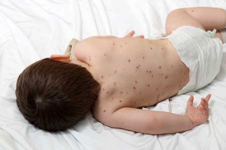 Une mère dénonce les dangers de l'ibuprofène en cas de varicelle